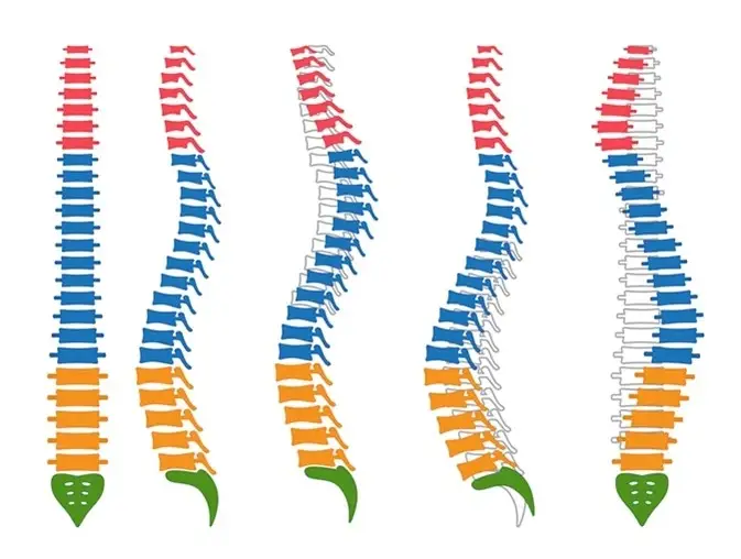 Spinal Deformity
