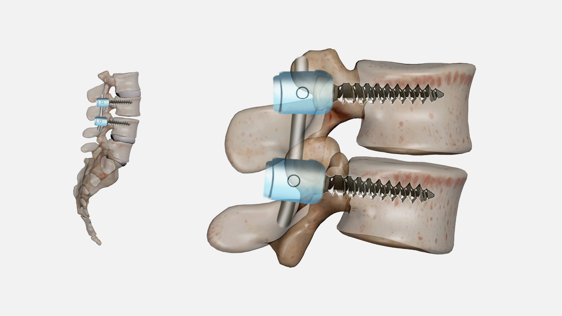Understanding Spinal Fixation and Fusion: A Comprehensive Guide