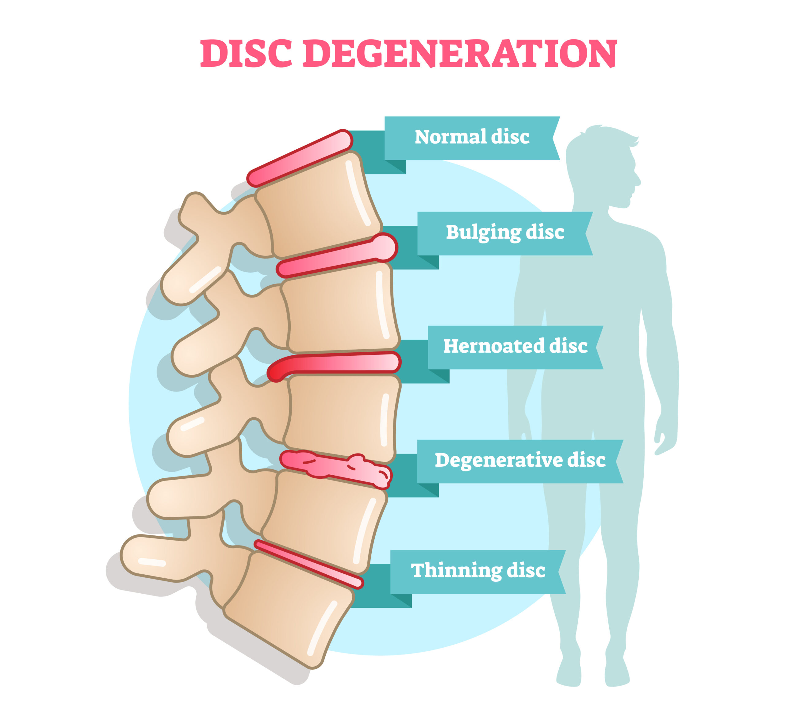 Degenerative Disc Disease: What You Need to Know