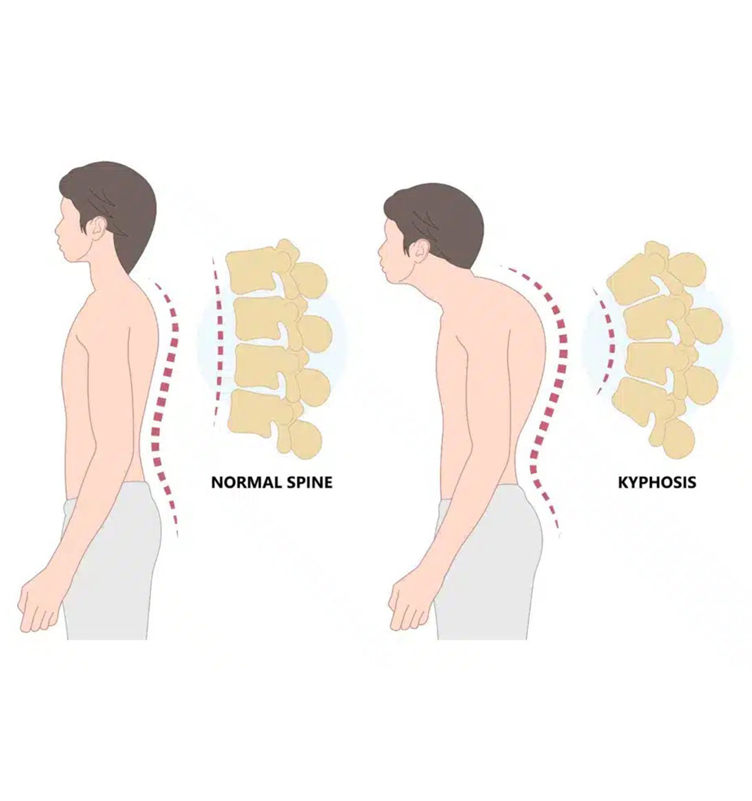 Kyphosis – Forward Bending of the Spine and Its Effects