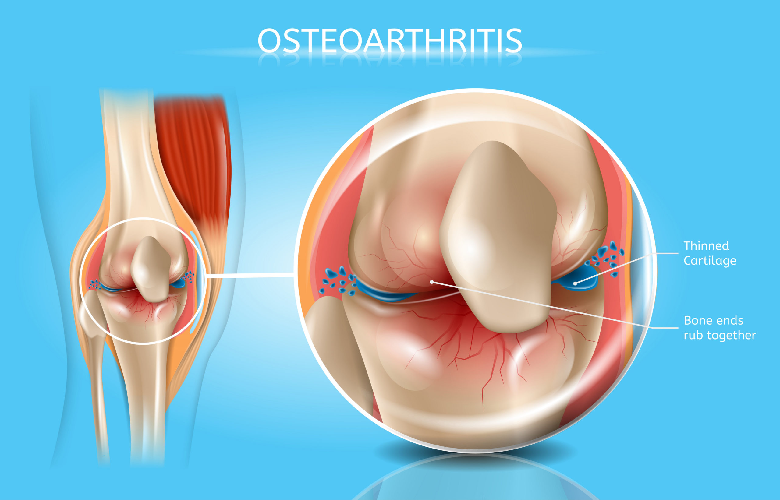 Understanding Osteoarthritis: Early Signs & Treatment Options