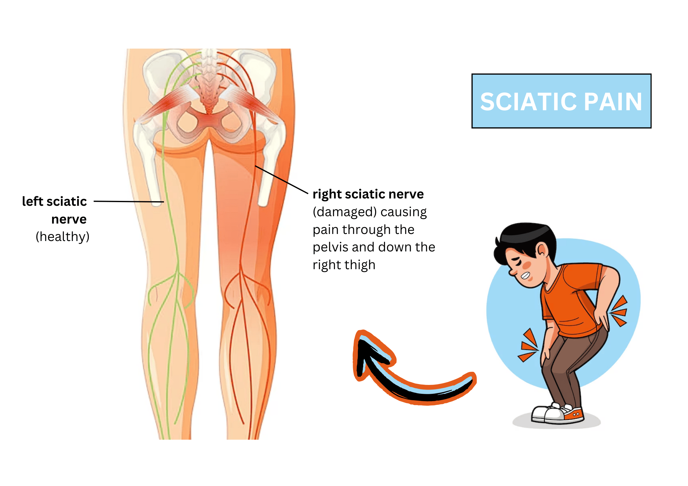 What Is Sciatica? Causes, Symptoms, and Treatment