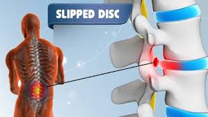 Signs You Might Have a Slipped Disc