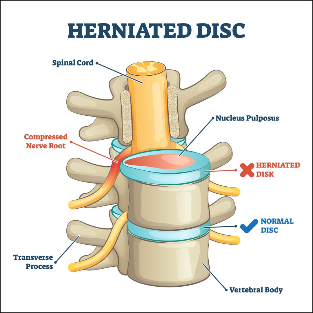 Understanding Herniated Disc: Causes, Symptoms & Treatment Options