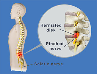 Warning Signs of Nerve Compression in the Spine