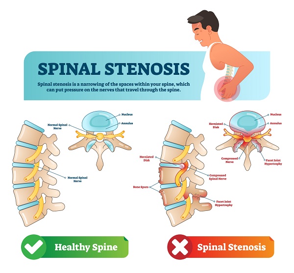 Understanding Lumbar Canal Stenosis: Causes, Symptoms, and Treatment