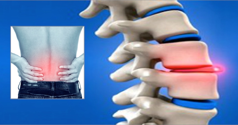 Causes and Treatment of Herniated Discs: Orthopaedic Care in Wakad